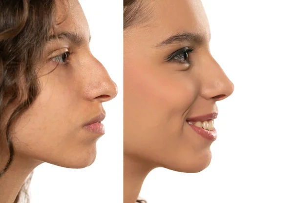 Kobieca Plastyka Nosa Kształt Nosa Kobiet Przed Operacji Plastycznej Woman — Zdjęcie stockowe