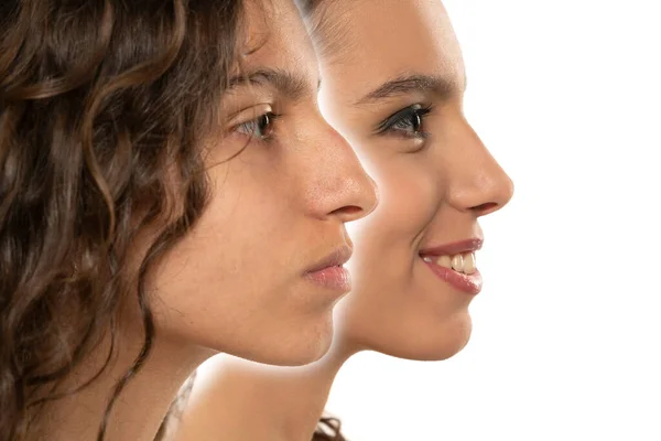 Nasenkorrektur Bei Frauen Frauen Nasenform Vor Und Nach Der Plastischen — Stockfoto
