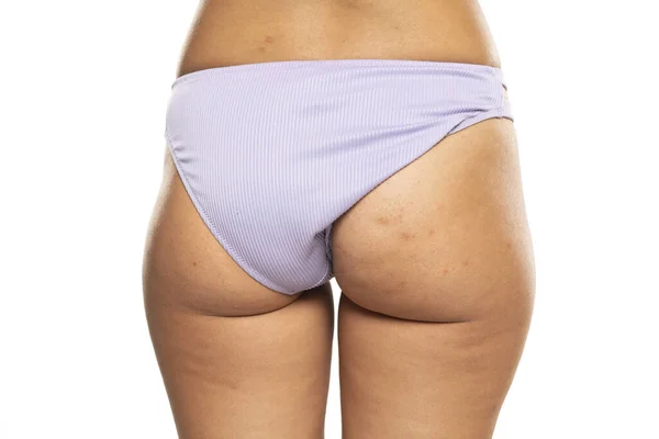 Female Buttocks Skin Problem Dark Spots Close White Studio Background — Stock Photo, Image