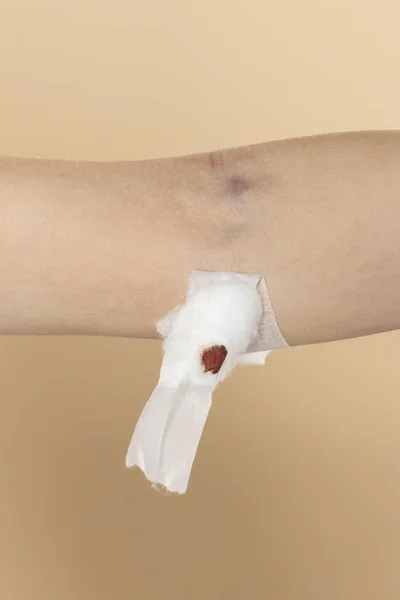 Paciente Mulher Mostrar Algodão Parar Sangrar Após Teste Coleta Sangue — Fotografia de Stock