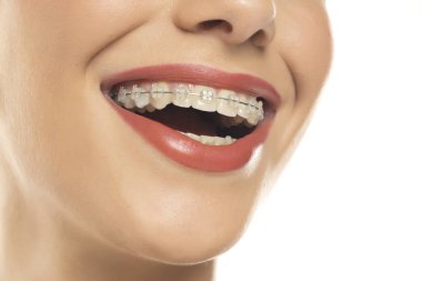 Diş telleri. Ortodontik tedavi. Diş bakımı konsepti. Kapanış Seramik ve Metal Parantez Dişler. Diş telleriyle gülümseyen güzel bir kadın. Güzel Kadın Sağlıklı Gülümse Beyaz Stüdyo arkaplanına yaklaş