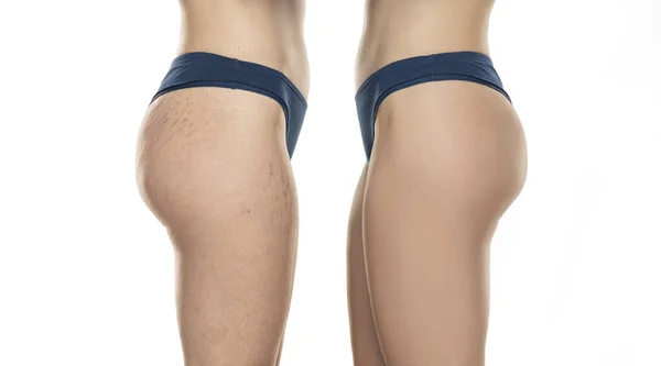 Comparación Antes Después Las Caderas Mujer Con Tratamiento Eliminación Estrías — Foto de Stock