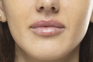 Doldurma işleminden sonra kadın dudaklarının kapatılması