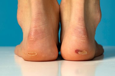 Ayakları su toplamış bir kadın. Topuklulardan yaralı ayak.