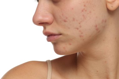 Sivilceli, çene hattı, cilt bakımı, beyaz arkaplan....