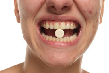 Sivilceli, dişlerinin arasında hap tutan genç bir kadın, beyaz arka planda stüdyo çekimi.