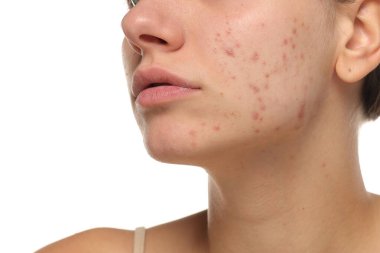 Sivilceli, çene hattı, cilt bakımı, beyaz arkaplan....