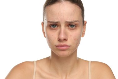 Sivilceli, üzgün, tedirgin, cilt bakımlı, beyaz arka planda genç bir kadının stüdyo fotoğrafı.