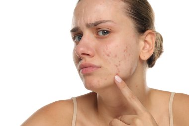 Beyaz arka planda akne eğilimli bir cildi gösteren genç bir kadının stüdyo fotoğrafı..