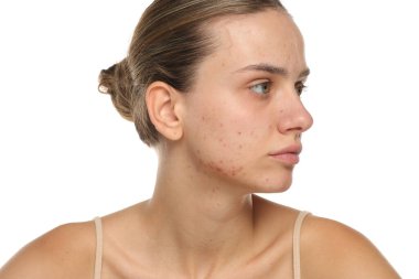 Sivilceli genç bir kadının atölye çekimi. Sakin bir ifade, cilt bakımı ve ten rengi.