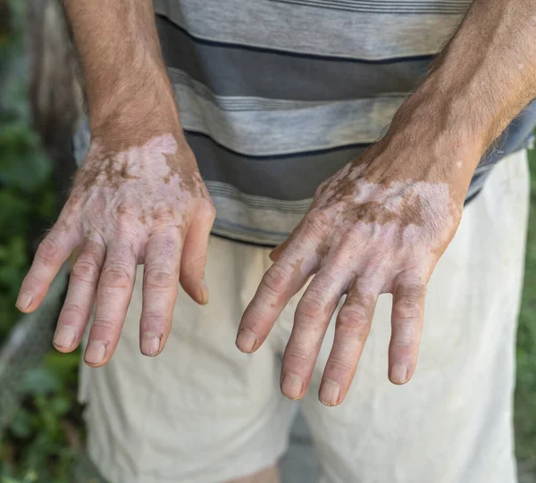 Symptoms Vitiligo Skin Man — Photo