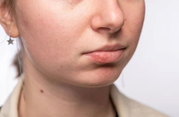 Close Girl Lips Affected Herpes — Stock Photo, Image