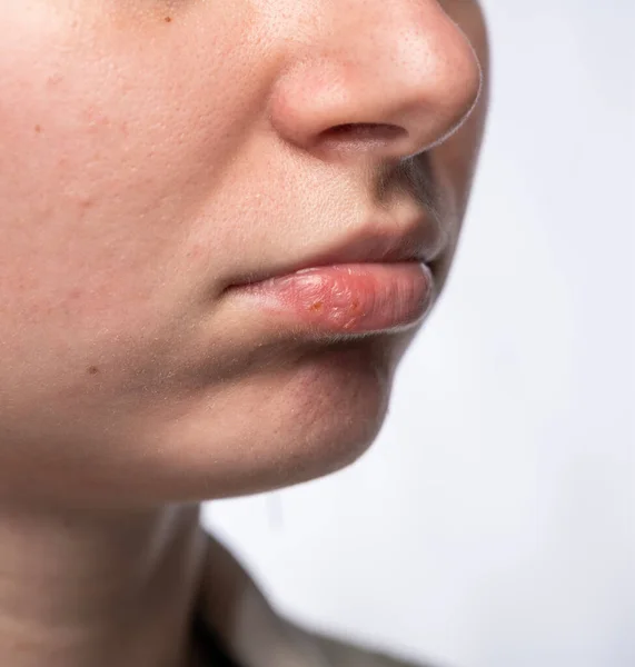 Close Girl Lips Affected Herpes — Stock Photo, Image