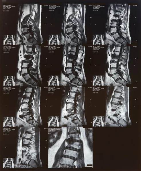 Magnetic resonance imaging. Spinal column detail. Medical procedure diagnosis. Radiology