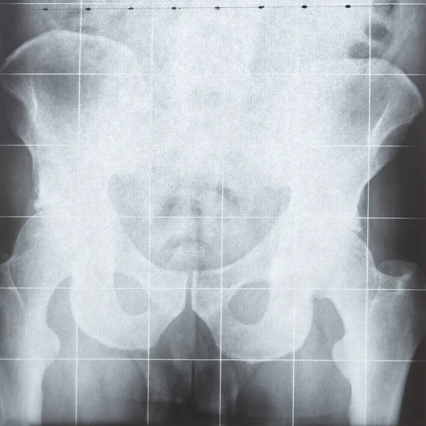 Rays Resonance Imaging Hip Detail Medical Procedure Diagnosis Radiology — Stock Photo, Image