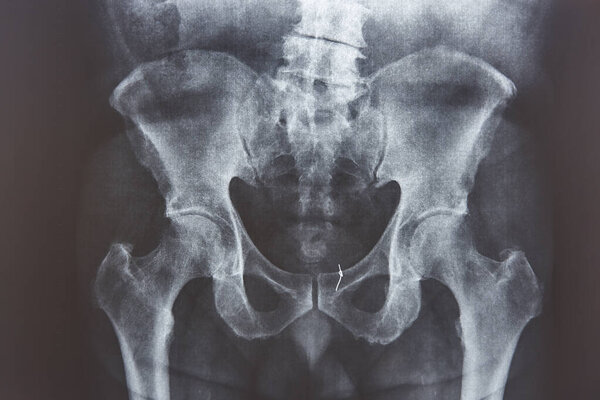 Hip xray. Gold thread attached on the bone. Medical examination