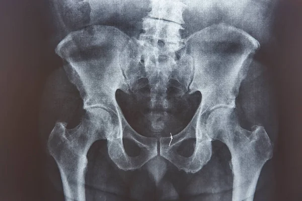 Hüft Röntgen Goldfaden Knochen Befestigt Medizinische Untersuchung lizenzfreie Stockbilder