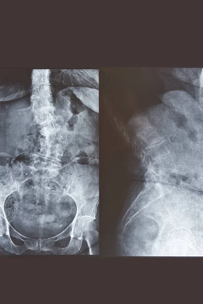Lumbar spine xray. Front and lateral view. Healthcare. Image diagnosis