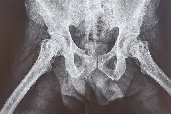 Hip axial xray. Gold thread attached on the bone. Examination
