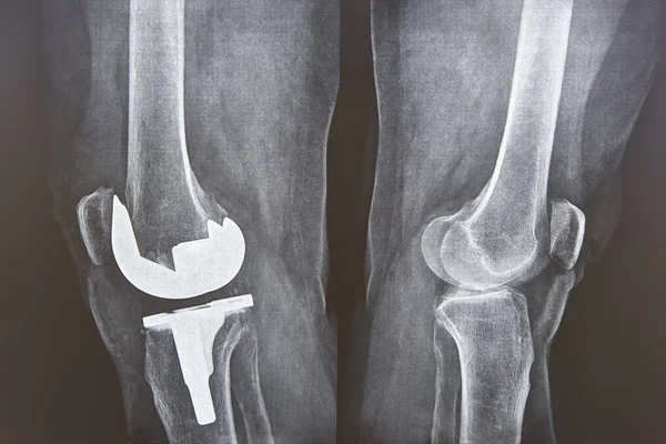 Knee Cap Replacement Xrays Titanium Implant Osteoarthritis Articular Cartilage — Stock Photo, Image