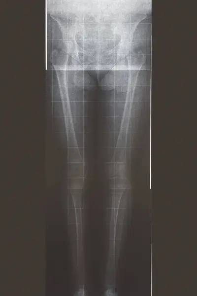 Legs and hip xray. Medical examination. Radiology diagnosis