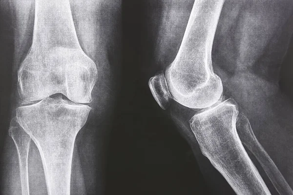 Knee xray. Front and lateral view. Healthcare. Image diagnosis