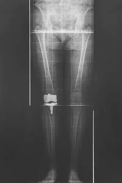 Legs and hip xray. Titanium knee implant. Radiology diagnosis