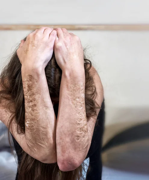 Woman covers her head behind arms with heavy Cuts and scars of self-mutilation in frustration, self-abusing, Borderline personality disorder in worry