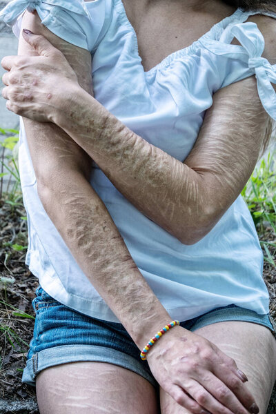 руки женщины с тяжелыми порезами и шрамами от самоувечья в разочаровании, самоистязании, пограничном расстройстве личности.