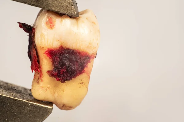 Human wisdom tooth inside a dental tool. Dentistry concept. Macro photo of a wisdom tooth close-up with a dental floss