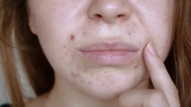 Deri sorunlarına yakın, sivilceli, sağlıksız cilt. Gözenekli, demodeks ve rosacea, kırmızı döküntüler. Sorunlu cilt bakımı kavramı. Alerjik ve kızarıklık