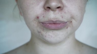 Deri sorunlarına yakın, sivilceli, sağlıksız cilt. Gözenekli, demodeks ve rosacea, kırmızı döküntüler. Sorunlu cilt bakımı kavramı. Alerjik ve kızarıklık