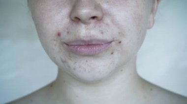 Deri sorunlarına yakın, sivilceli, sağlıksız cilt. Gözenekli, demodeks ve rosacea, kırmızı döküntüler. Sorunlu cilt bakımı kavramı. Alerjik ve kızarıklık