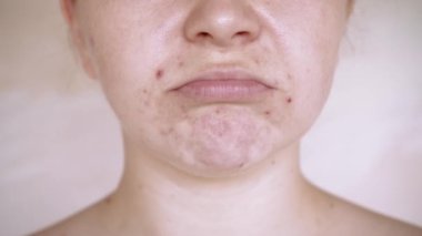 Deri sorunlarına yakın, sivilceli, sağlıksız cilt. Gözenekli, demodeks ve rosacea, kırmızı döküntüler. Sorunlu cilt bakımı kavramı. Alerjik ve kızarıklık