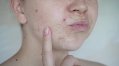 Deri sorunlarına yakın, sivilceli, sağlıksız cilt. Gözenekli, demodeks ve rosacea, kırmızı döküntüler. Sorunlu cilt bakımı kavramı. Alerjik ve kızarıklık