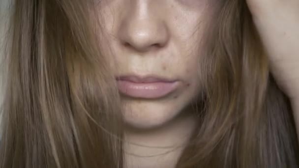 Close Skin Problems Unhealthy Skin Acne Pimples Porous Demodex Rosacea — Video