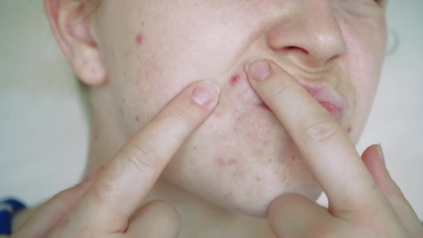 皮膚の問題を閉じます にきびやにきびと不健康な皮膚 多孔質 デモデックスと酒 赤い発疹 問題の肌のケアの概念 アレルギー — ストック動画