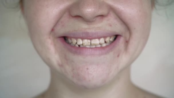 女孩笑了 在牙齿上露出了一个白色的斑点 在女性的牙齿上出现了氟中毒 中年妇女的天然牙齿 下巴关节功能障碍 医疗及牙科护理的概念 — 图库视频影像