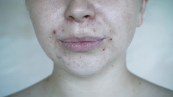 Närbild Hudproblem Ohälsosam Hud Med Akne Och Finnar Porösa Demodex — Stockvideo