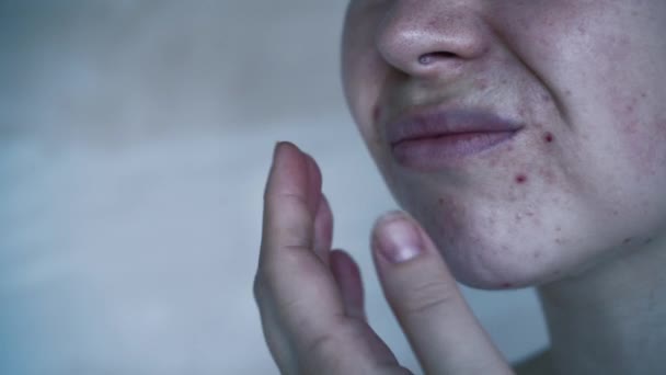 Close Skin Problems Unhealthy Skin Acne Pimples Porous Demodex Rosacea — Vídeo de Stock