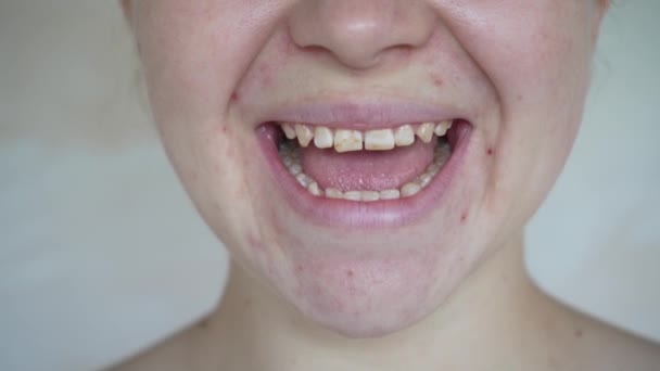 Ένα Νεαρό Κορίτσι Χαμογελάει Και Δείχνει Στραβά Δόντια Έννοια Των — Αρχείο Βίντεο