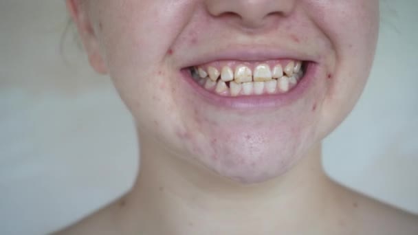 女の子は笑顔で 歯に白い斑点 女性の歯のフッ素症を示しています 中年女性の自然な歯 顎関節の機能障害 医療と歯科医療の概念 — ストック動画
