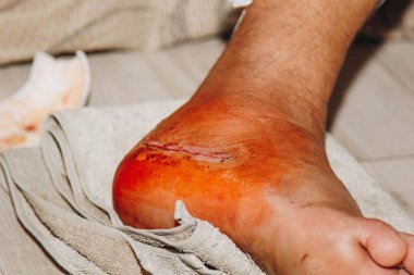 Ayak değiştirme ameliyatından sonra bacağında bir yara izi. Kırık bacak kemiği. Kapatın. Acı, travma, yara tedavisi