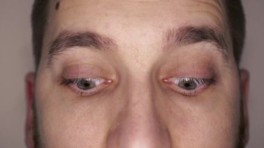 Kılcal damarları olan yeşil gözler. Optalmoloji ve tıp kavramı. Farklı yönlere bakar