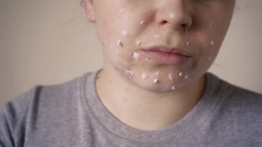 Deri sorunlarına yakın, sivilceli, sağlıksız cilt. Gözenekli, demodeks ve rosacea, kırmızı döküntüler. Sorunlu cilt bakımı kavramı. Alerjik ve kızarıklık