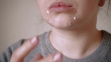 Deri sorunlarına yakın, sivilceli, sağlıksız cilt. Gözenekli, demodeks ve rosacea, kırmızı döküntüler. Sorunlu cilt bakımı kavramı. Alerjik ve kızarıklık