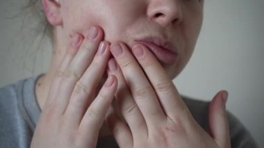 Deri sorunlarına yakın, sivilceli, sağlıksız cilt. Gözenekli, demodeks ve rosacea, kırmızı döküntüler. Sorunlu cilt bakımı kavramı. Alerjik ve kızarıklık