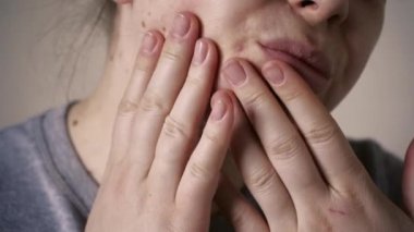 Deri sorunlarına yakın, sivilceli, sağlıksız cilt. Gözenekli, demodeks ve rosacea, kırmızı döküntüler. Sorunlu cilt bakımı kavramı. Alerjik ve kızarıklık