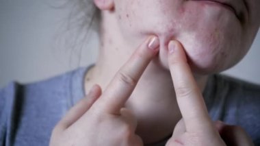 Deri sorunlarına yakın, sivilceli, sağlıksız cilt. Gözenekli, demodeks ve rosacea, kırmızı döküntüler. Sorunlu cilt bakımı kavramı. Alerjik ve kızarıklık