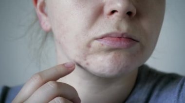 Deri sorunlarına yakın, sivilceli, sağlıksız cilt. Gözenekli, demodeks ve rosacea, kırmızı döküntüler. Sorunlu cilt bakımı kavramı. Alerjik ve kızarıklık